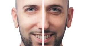 Hombre antes y después de las ojeras
