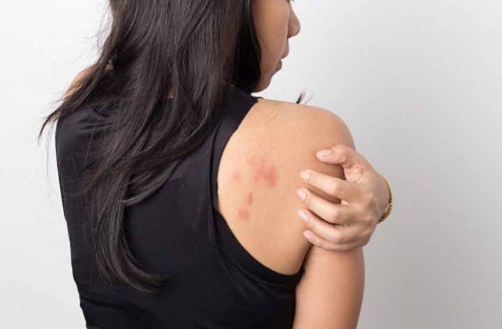 mujer con alergia en piel