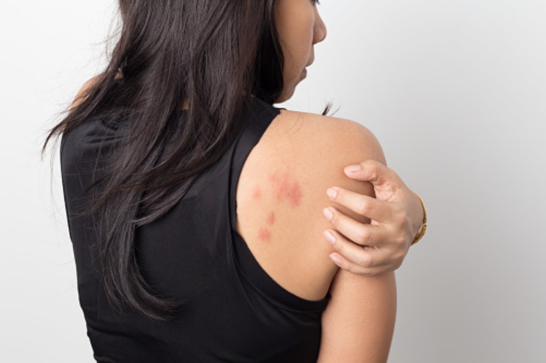 mujer con alergia en piel