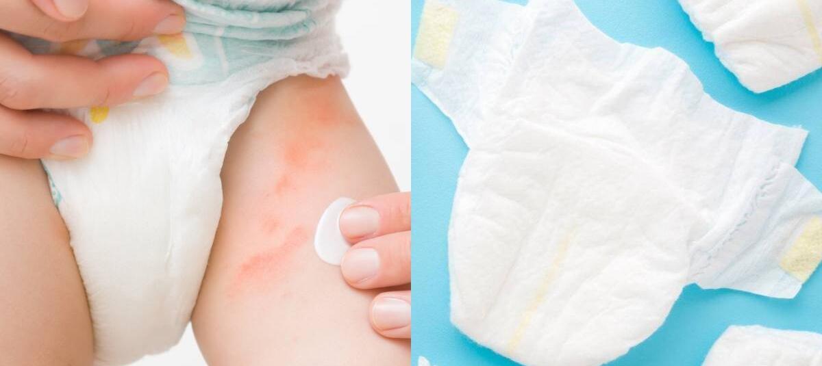 La dermatitis del pañal en bebés